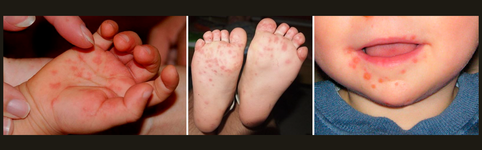 How Did Hand Foot And Mouth Disease Start