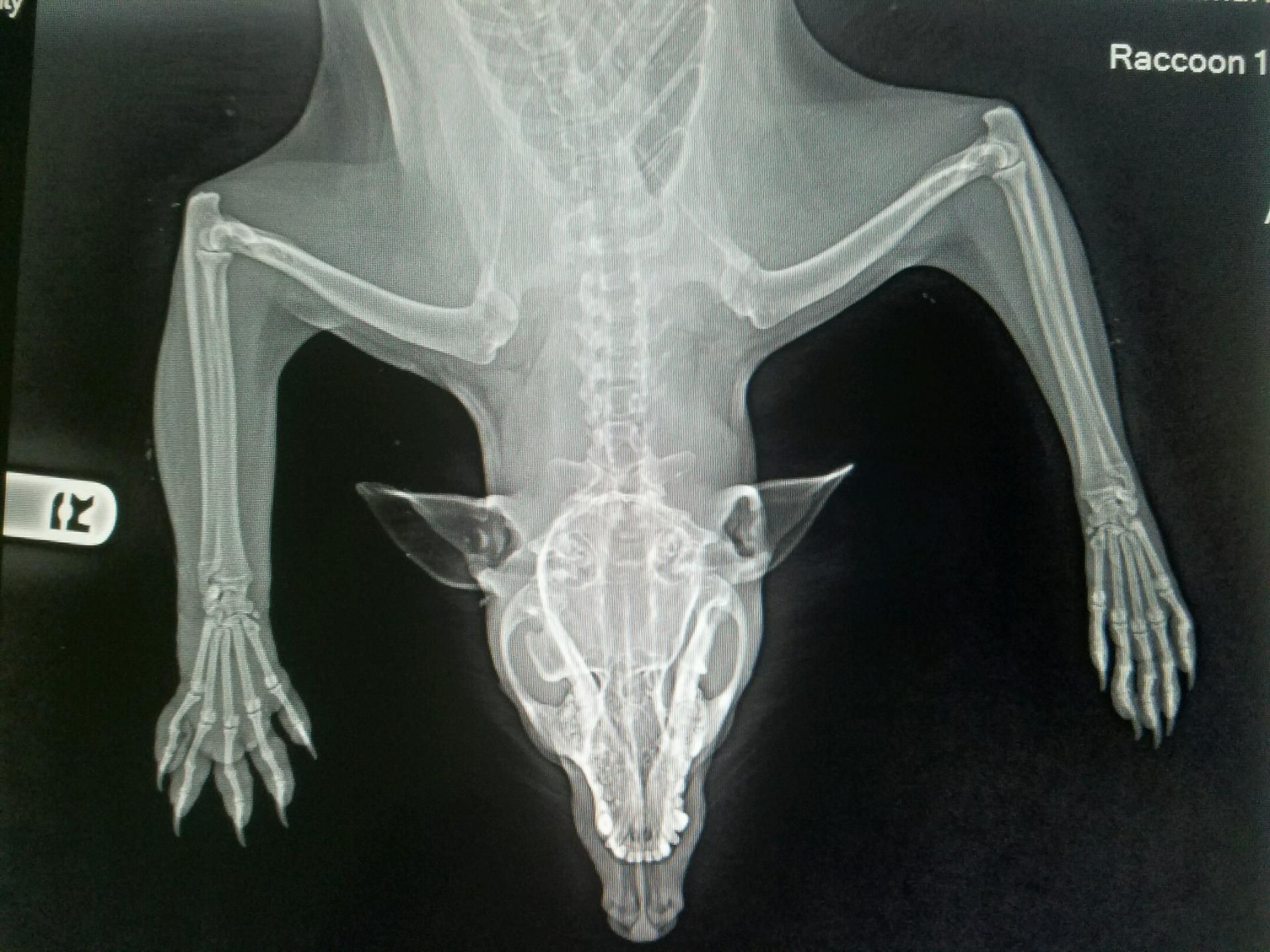 This x-ray shows no breaks, but if you compare the right arm to the left, you can see the swelling throughout the arm.