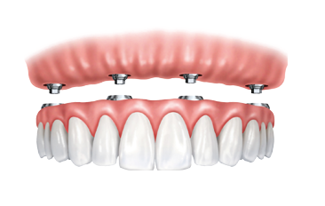 What To Know About Full Arch Dental Implants