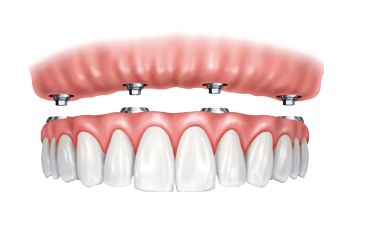 denture implants