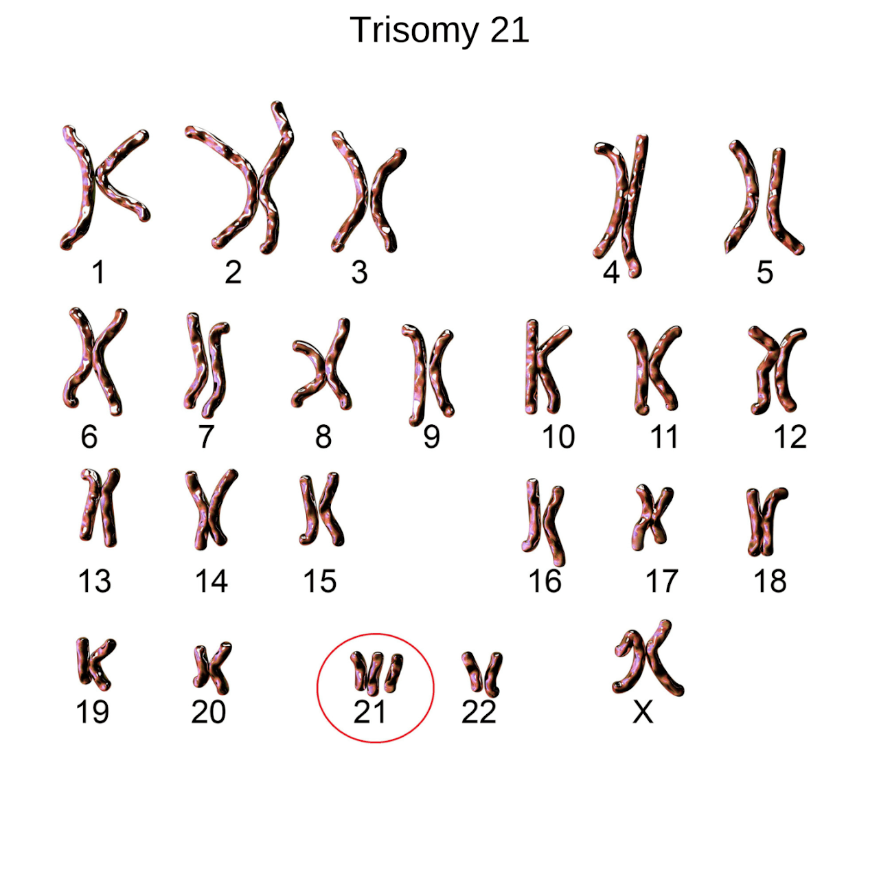 Trisomy 21