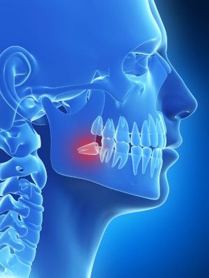 implacted wisdom teeth removal