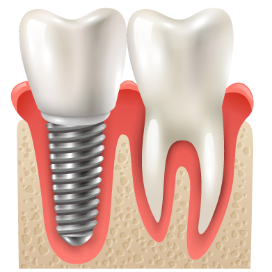 Best dentist for dental implants near me