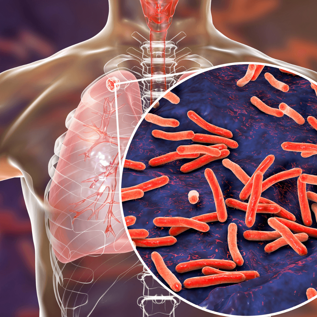 Tuberculosis Cases Increasing in Iowa Among Persons from Pacific Island Communities